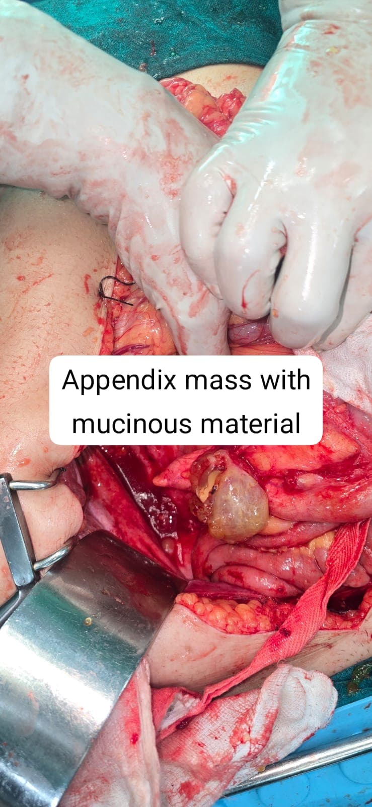 Successful CRS and HIPEC for Pseudomyxoma Peritonei from Low-Grade Appendiceal Mucinous Neoplasm