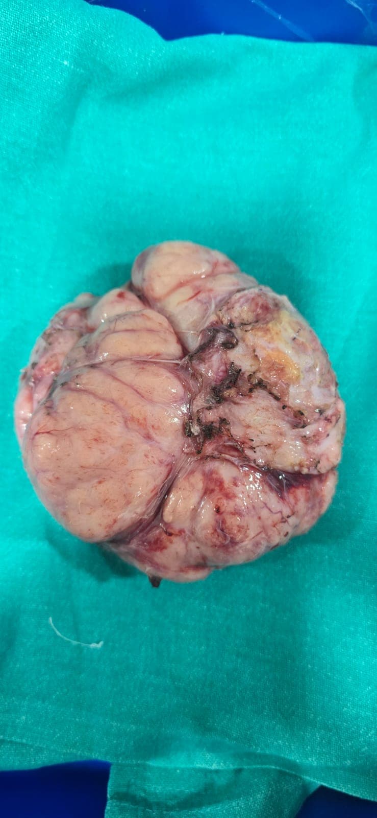 Successful Excision of Giant Fibroadenoma in a 12-Year-Old Girl
