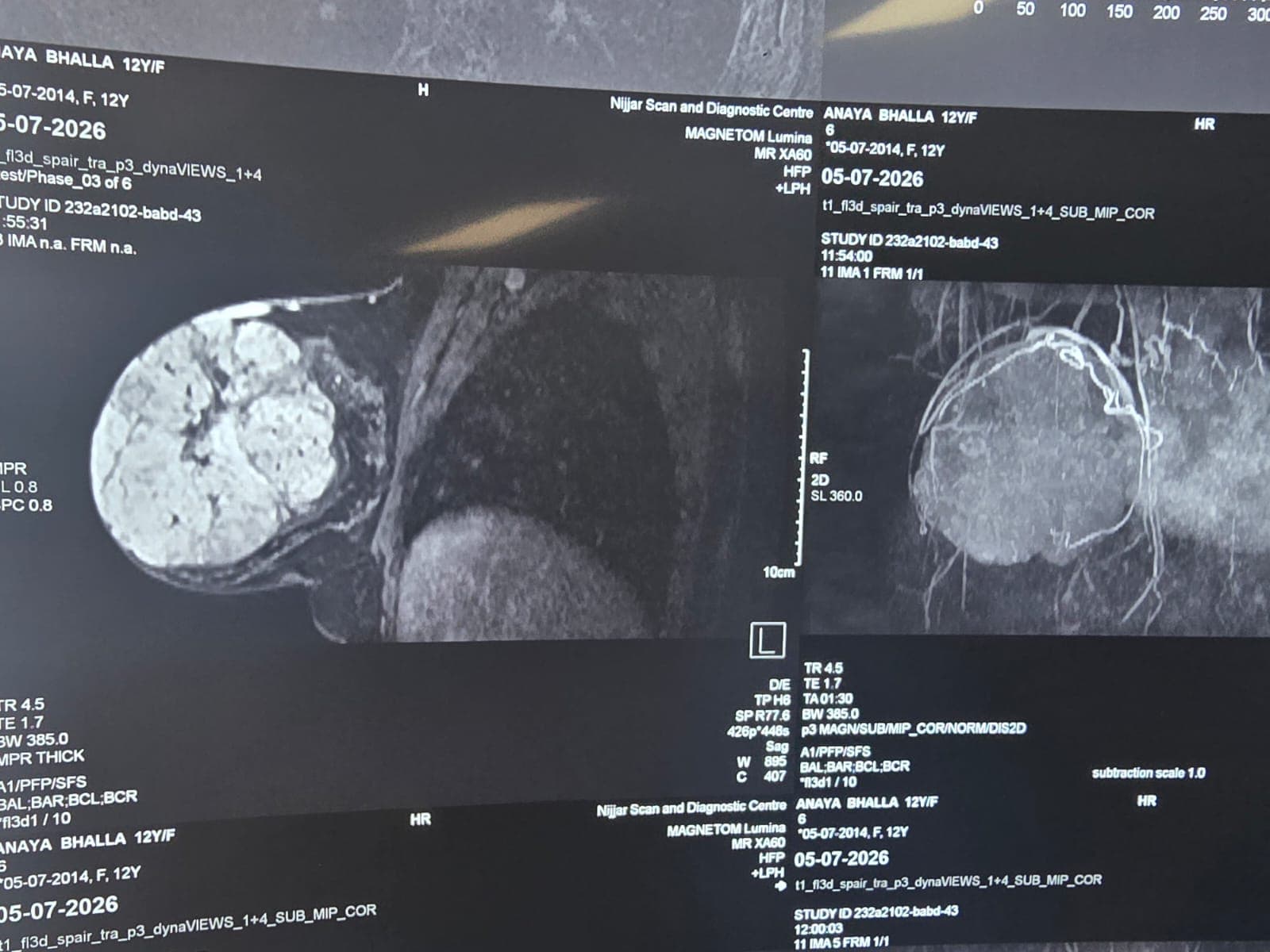Successful Management of Bilateral Giant Juvenile Fibroadenomas