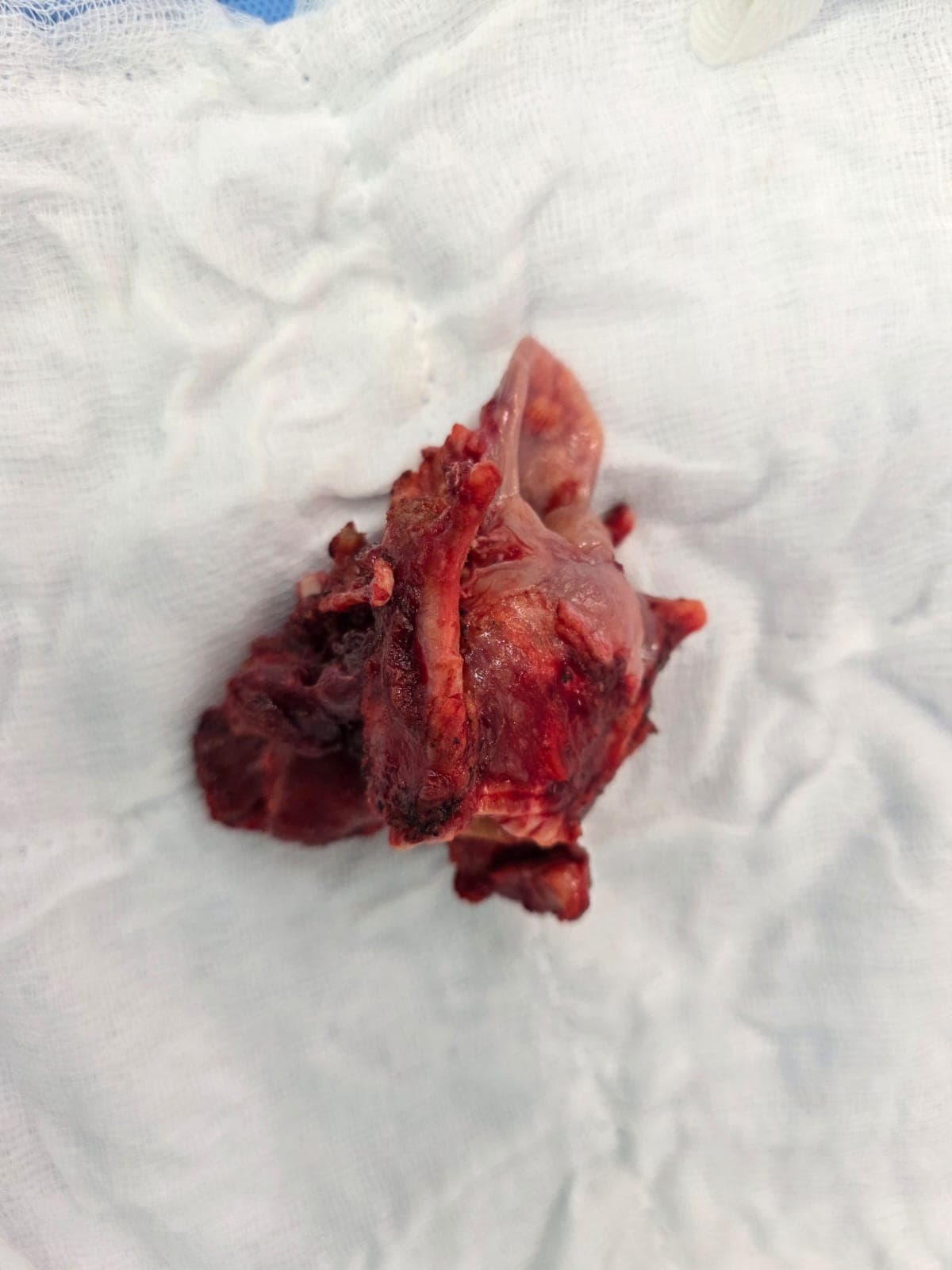 Successful Surgical Management of Recurrent Pyriform Fossa Cancer